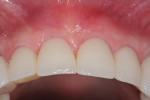 Fig 35. Facial-occlusal view showing the thickened “phenotype conversion” maintained after 3.5 years, Nos. 7 through 10.