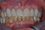 Fig 10. Fabrication/delivery of laboratory-processed fixed temporary restorations Nos. 6 through 11 (restorative therapy: Dr. Zola A. Makrauer).