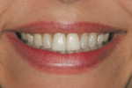 Figure 12  The highly esthetic provisional restoration after cementation.