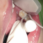Fig 2 and Fig 3. Placement of SDF on an approximal caries lesion using woven floss. Floss is placed between the teeth (Fig 2), then SDF is applied to the floss, and allowed to soak in for at least 1 minute (Fig 3). Note the corner of the mouth is well-protected from the blue SDF on the floss with a gloved finger. (Photographs courtesy of Jeanette MacLean, DDS)