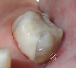 Fig 4 and Fig 5. SDF application 1 minute and conventional GIC restoration on the same day. Fig 4: Before restoration, after SDF placement. Fig 5: Immediate postoperative. There is some dark show-through around the marginal areas because of inadequate caries removal around the perimeter of the lesion. For a more esthetic result, clean 2 mm from the cavosurface margins when enamel is present and 1 mm if there is no enamel in the deeper root areas. (Photographs courtesy of Kenneth Han, DDS)