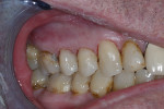 Fig 6 and Fig 7. Restoration of SDF-treated dentin with resin composite. Fig 6: Arrest achieved on teeth Nos. 4 and 5 buccal via two prior applications of SDF. Fig 7: Conservative preparation on Nos. 4 and 5 focused on external walls only, ie, enamel margins and DEJ. A RMGI liner was placed on SDF-stained axial wall dentin as an opaquer, followed by typical etch/primer/adhesive technique for resin composite restoration. Also, note glass-ionomer restoration on mesial No. 30; arrest with SDF and conservative preparation similar to Nos. 4 and 5. (Photographs courtesy of Dan Bentley, DDS)