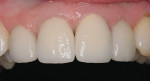 Figure 5  Final postoperative photograph of cemented veneers on teeth Nos. 7 and 10 and Captek Nano crowns on teeth Nos. 8 and 9.