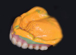 The intaglio surface of the existing denture is refreshed using a VPS material technique.