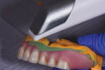 Extraoral digitization of the VPS wash-relined denture with an intraoral scanner.