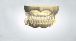 The prototype data imported into the denture design module.