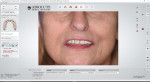 The diagnostic proposal matched with and superimposed over the preoperative smile picture.