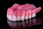 Carded teeth were luted into the base to complete the final prosthesis.