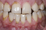 Figure 2  A dental examination and full-mouth radiographs and panorex of this 43-year-old woman revealed an AAP Type 1 periodontal diagnosis with probing depths ranging from 3 mm to 5 mm, with the exception of all remaining (maxillary and mandibular)