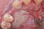 Figure 6  The outside of the remaining defect was covered with a membrane derived from the patient’s blood.