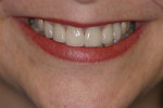 Figure 9: The laboratory fabricated single-unit IPS e.max<sup>®</sup> Press restorations; the patient was very pleased with the final results.