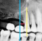 Fig 1. Measurement on CBCT: Blue line indicates that the area being measured is parallel to the long axis of the adjacent tooth.