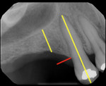 Fig 3. Measurement on PA of case shown in Fig 1 and Fig 2: Area of interest is parallel to the long axis of the adjacent natural tooth, extending from the crest of the ridge to the floor of the maxillary sinus.