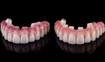 Fig 6. Zirconia final restoration (left), which was copy-milled from the PMMA prototype (right).