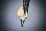 Fig 1 and Fig 2. Intraorally fabricated provisional restoration for replacement of maxillary central and lateral incisors. It is made of composite shell fabricated by the technician, picked up intraorally on a titanium temporary abutment, and the emergence contour area was added and refined in the in-office laboratory with flowable composite.