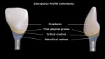 Fig 3. Diagram mirroring the key concepts of the provisional in Fig 1 and Fig 2. Most importantly, the emergence contours are narrow and smooth until they merge out to meet the crown form in the “critical contour” area. (Illustration based on the concepts presented by Su H, et al. Int J Periodontics Restorative Dent. 2010;30(4):335-343.)