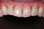 Fig 9 through Fig 11. Soft-tissue contours and positions at placement of the definitive restorations, illustrating the open gingival embrasures resulting from the lack of provisionals or custom healing abutments during the healing stage.