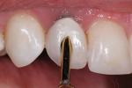 Fig 14. The patient would return at follow-up (at least 6 weeks) for evaluation of tissue migration, and approximately 80% of the recession was resolved. The remaining recession would be mitigated by moving the restoration margin apically 0.5 mm. The provisional was screw-retained even though the definitive will be cement-retained. The composite material used for the crown portion can be easily modified, repaired, or used to mask the access hole.