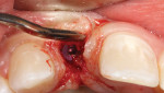 Fig 16. Patient presented for uncovering appointment of a two-staged lateral incisor implant.