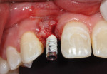 Fig 17. Immediate intraoral composite/tibase provisional fabrication was performed.