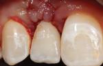 Fig 20. Note undercontoured emergence contours allowing space for gingival migration coronally.