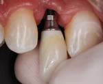 Fig 22. Implant site at insertion of the definitive screw-retained zirconia/tibase definitive restoration.