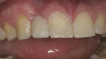 Figure 5  Lateral view of the pontic after addition of composite resin raised the gingival height.