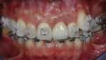 Fig 3. Failing maxillary left central incisor with previous endodontic surgery and chronic fistula.