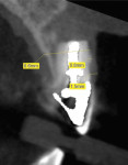 Fig 4 and Fig 5. Radiograph and CBCT of failing maxillary left central incisor with previous endodontic surgery and chronic fistula.