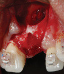 Fig 8. Large bone defect from previous endodontic surgery and chronic infection.