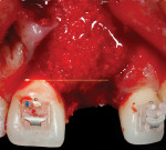 Fig 9. Mineralized allograft was strategically placed to overcorrect the buccal crest defect to attain a favorable gingival margin.