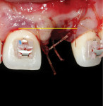 Fig 11 and Fig 12. One of the primary goals of bone augmentation in the esthetic zone is to bring the gingival margin and bone into a more coronal level prior to implant placement. Note the more favorable gingival margin level after 4 months of healing (Fig12). This was achieved through graft containment and prevention of graft migration from the buccal bone crest.