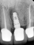 Fig 17. Radiograph of restored implant at 2-year follow-up.