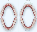 Fig 3. Invisalign ClinCheck showing
occlusal view before (left) and after (right)
Invisalign clear aligner therapy. All mandibular spaces were closed and interproximal reduction was performed between the mandibular anterior teeth to allow further closure of maxillary spaces.