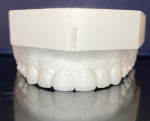 Fig 4. Pre-prosthetic lab wax-up of teeth Nos. 6 through 11 to be used as a template for the restorative treatment. Bioclear restorations utilizing additive dentistry (ie, no tooth structure resected) were treatment planned.