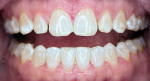 Fig 5. Intraoral anterior view after completion of Invisalign clear aligner therapy and whitening (Invisalign attachments on teeth).