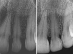 Fig 7. Before (left) and after (right) radiographs of teeth Nos. 9 through 11, highlighting the infinity margins of Bioclear restorations.