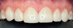 Fig 8. Intraoral maxillary anterior view after
completion of Bioclear composite restorations on teeth Nos. 6 through 11 and removal of Invisalign attachments by polishing.