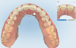 Fig 9. TimeLapse technology (occlusal view) on the iTero Element highlights changes in dentition between scans. The scan in the upper right corner was taken prior to Invisalign treatment, while the comparison scan was done after the Bioclear restorations. Hovering over teeth Nos. 8 and 9 allows the patient to see the transformation of the teeth.