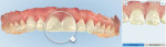 Fig 10. TimeLapse technology on the iTero Element highlights changes in dentition between scans. The first scan (right) was Fig 10. TimeLapse on the iTero from the buccal view.