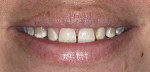 Fig 11 and Fig 12. Extraoral view of patient’s smile before (Fig 11) and after (Fig 12) treatment