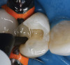 Figure 15 ENDODONTIC AND ESTHETIC PARAMETERS  The same teeth after crown lengthening and a new restoration created a more esthetically pleasing 80% height-to-width ratio.