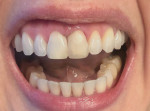 Fig 1. Photograph sent to the author displaying the overcontoured resin on the mesial of tooth No. 9, long contact, and inflamed papilla between the two central incisors.