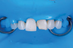 Fig 8. The completed resin on tooth No. 8 prior to final polish. The tooth was shaped and contoured with flexible discs (FlexiDiscs , Cosmedent, cosmedent.com).