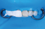 Fig 10. The lingual shelf shown here was created using a putty matrix built off of the original teeth. The resin used for this was an achromatic enamel in Milky White shade (Estelite Omega, Tokuyama, tokuyama-us.com).
