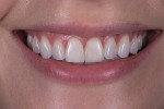 Fig 13. Final postoperative smile.
