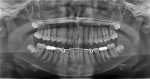 Fig 3. Initial panoramic X-ray showing full permanent dentition, crowding, and midline deviation.