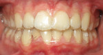 Fig 6. Six-month revision trays insertion appointment. Only one engager, on tooth No. 21, was used at this time. The trays fit well, and much improvement was noted in arches expansion and crowding. The midline was now corrected.