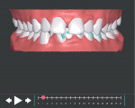 Fig 7. Initial ClearCorrect treatment setup showing engagers (in green) on the lower teeth. The deep bite, crowding, and arch constriction were clearly evident.