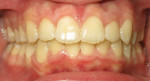 Fig 10. Patient’s intraoral condition showing final correction, which included all crowding, the midline, improved gingival recession, and closed diastema. The bite was now ideal, and the archforms improved. The treatment was succesfully completed after 10 months using only ClearCorrect aligners.